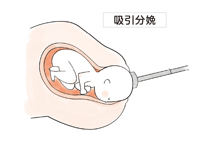 吸引分娩