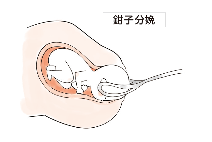 鉗子分娩