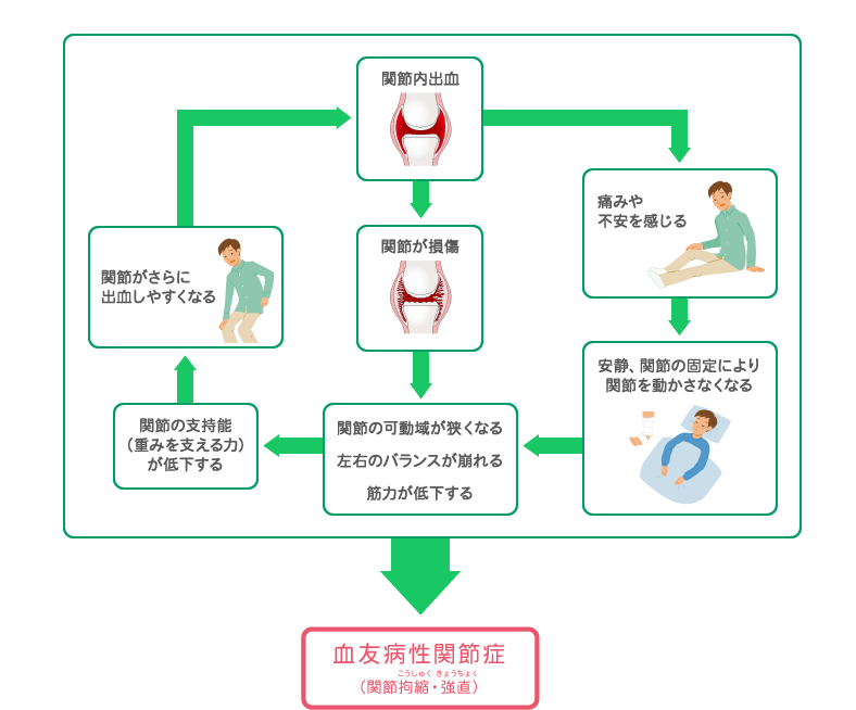 関節内出血　関節が損傷　関節の可動域が狭くなる　左右のバランスが崩れる　筋力が低下する　関節の可動域が狭くなる　左右のバランスが崩れる　筋力が低下する　関節がさらに出血しやすくなる　関節がさらに出血しやすくなる　安静、関節の固定により関節を動かさなくなる