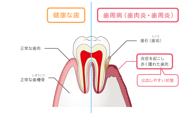 歯みがきの徹底
