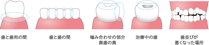歯と歯肉の間 歯と歯の間 噛み合わせの部分奥歯の奥 治療中の歯 歯並びが悪くなった場所