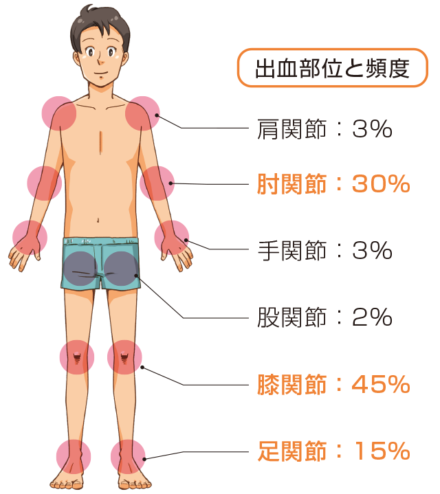 関節内出血