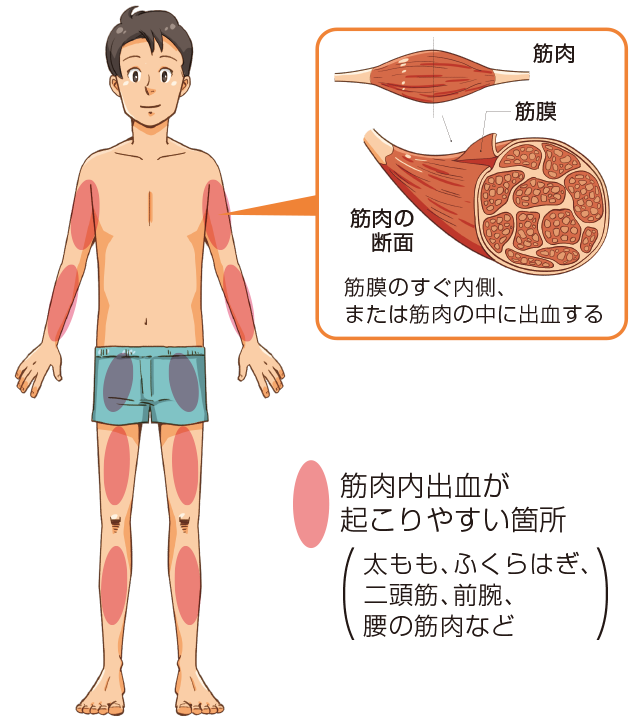 筋肉内出血