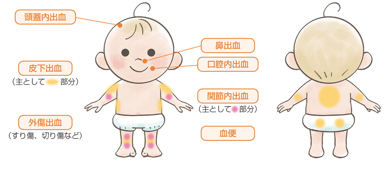 乳幼児期にみられる主な出血部位