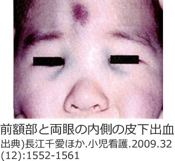 前額部と両眼の内側の皮下出血