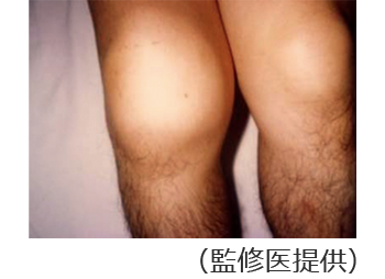関節内・筋肉内出血