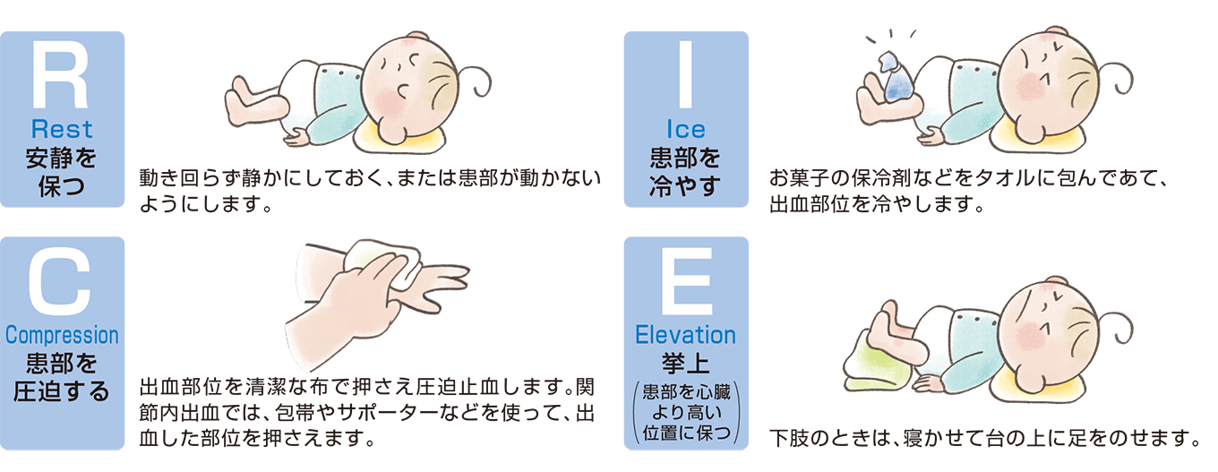出血時の応急処置：ＲＩＣＥ（ライス）