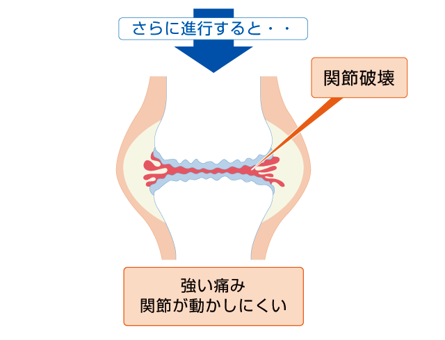 血友病性関節症