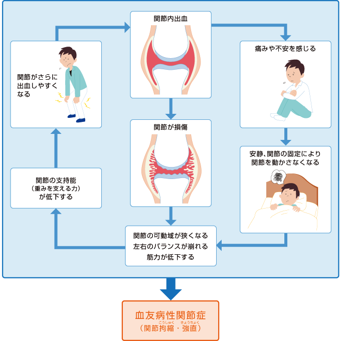 血友病性関節症